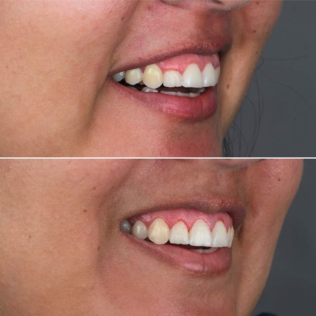 Gengivoplastia