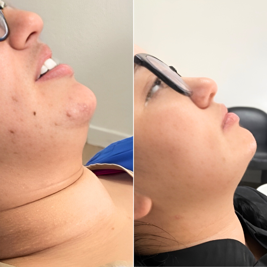 Lipo de papada (enzimática)