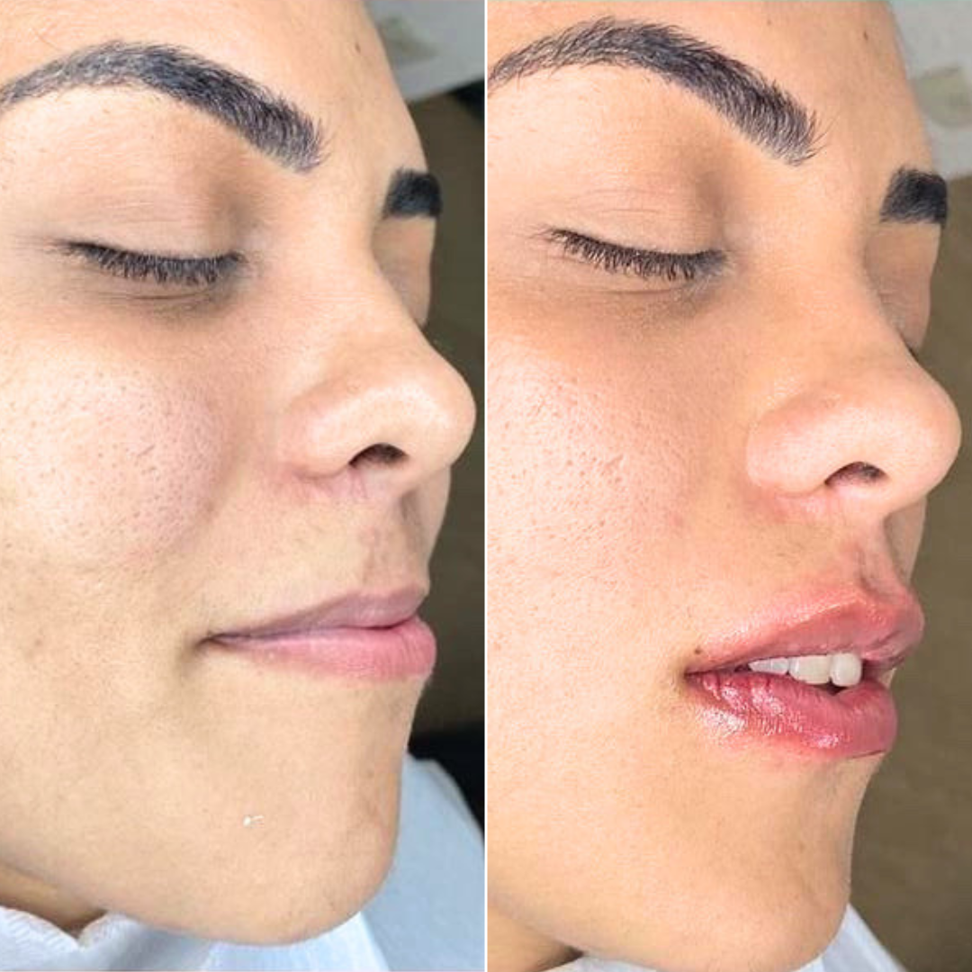 Preenchimento labial