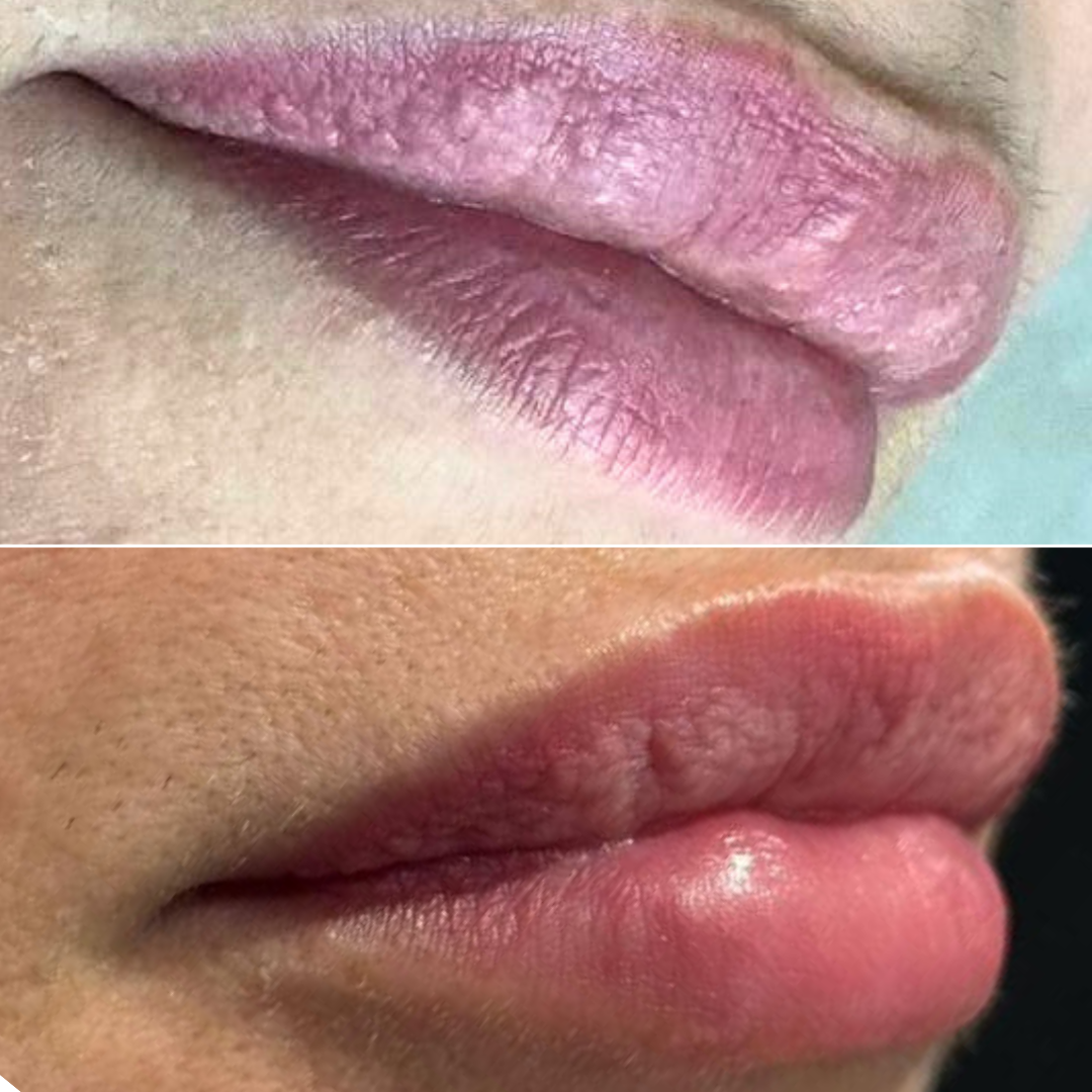 Preenchimento labial