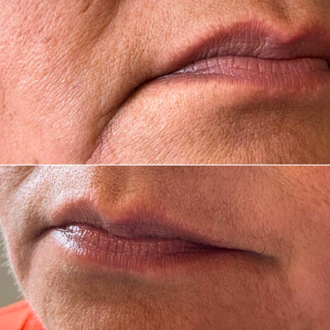 Preenchimento de linha de marionete (boca triste)