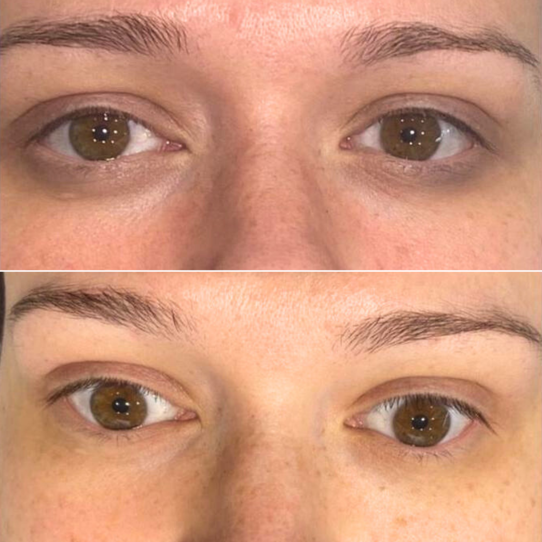 Preenchimento de olheiras