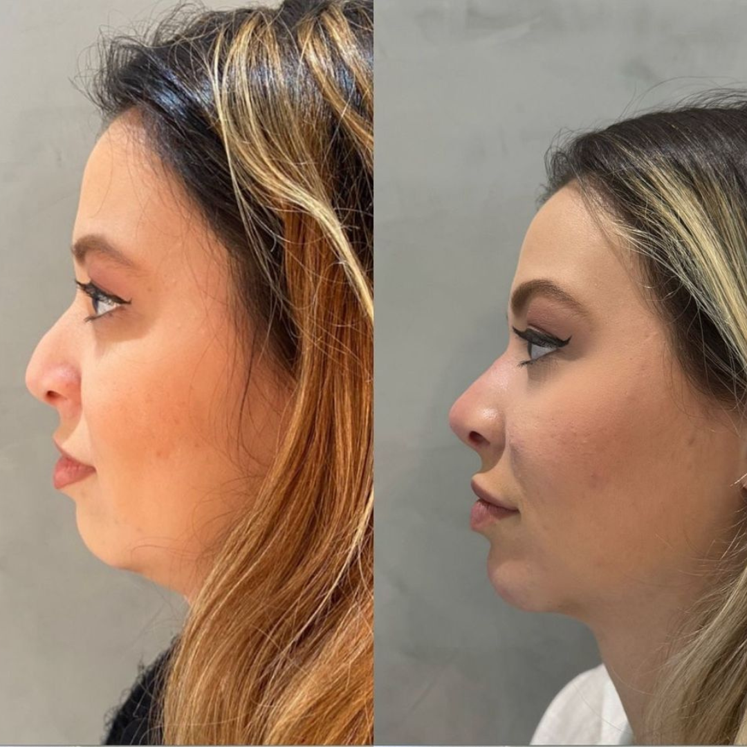 Rinomodelação, preenchimento de queixo e preenchimento labial